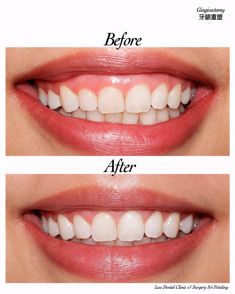 Before and after gingivectomy treatment improving gummy smile and smile aesthetics.