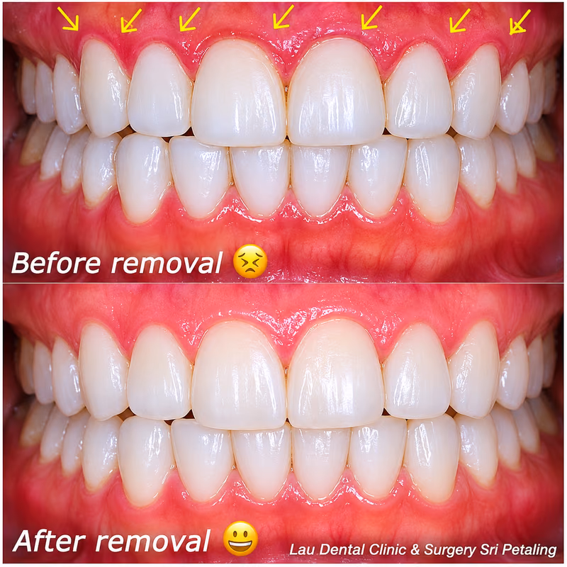 Gingivectomy removing excess gum tissue around the front teeth, restoring a healthier and more even gumline.