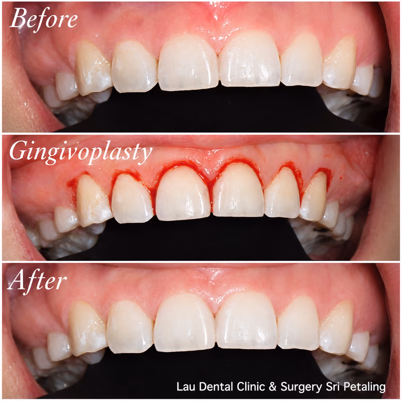 Gingivoplasty gum reshaping treatment creating a more even gumline and balanced front tooth appearance.