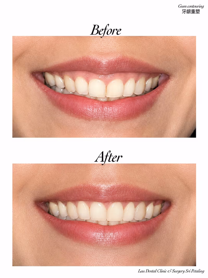Before and after gum contouring treatment creating a more balanced and aesthetically pleasing smile.