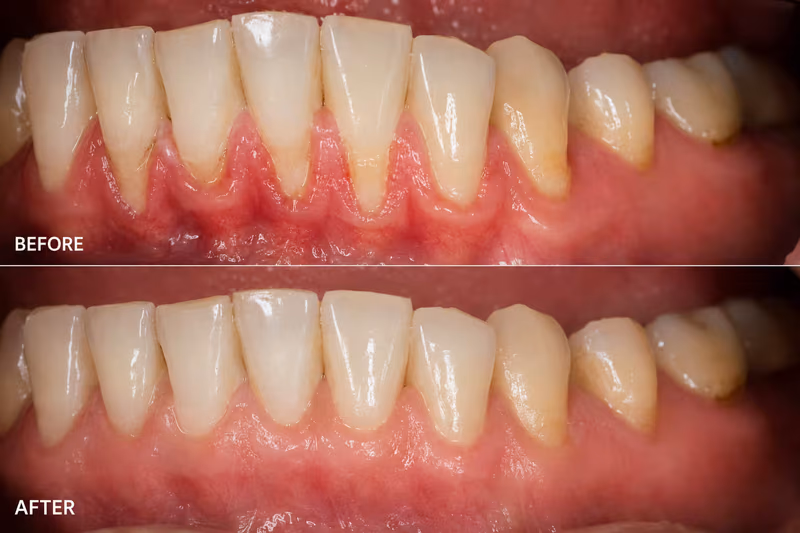 Before and after comparison of a successful gum grafting surgery showing treatment for severe gum recession.