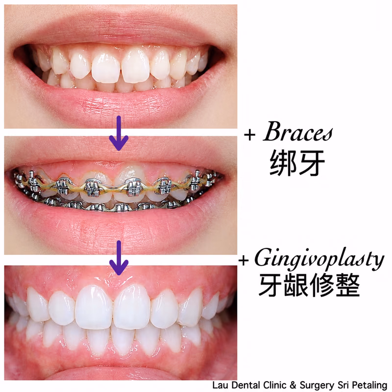 Combined braces and gingivoplasty treatment correcting a gummy smile for a more balanced, natural smile line.