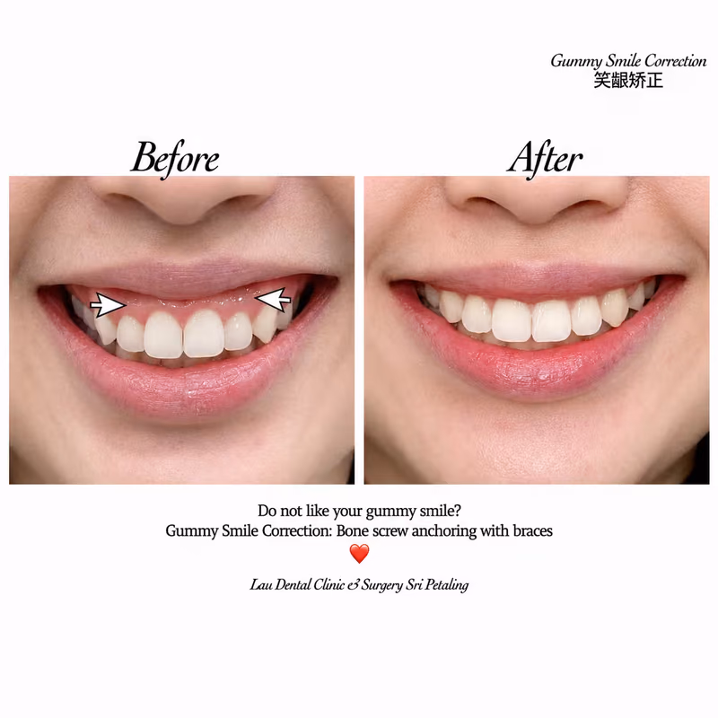 Before and after gummy smile correction with braces for a more balanced smile.