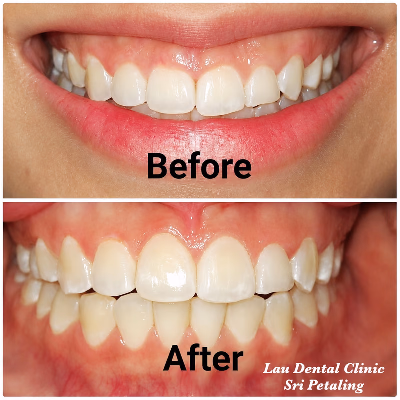 Gummy smile correction treatment improving the gumline for a more proportionate and natural-looking smile.