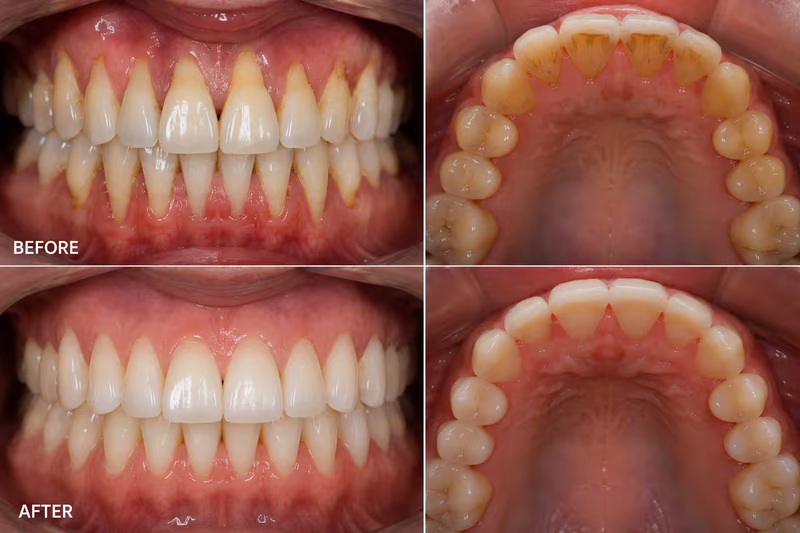 Before and after views of gum graft surgery showing full root coverage for receding gums and complete healing of the upper palate.