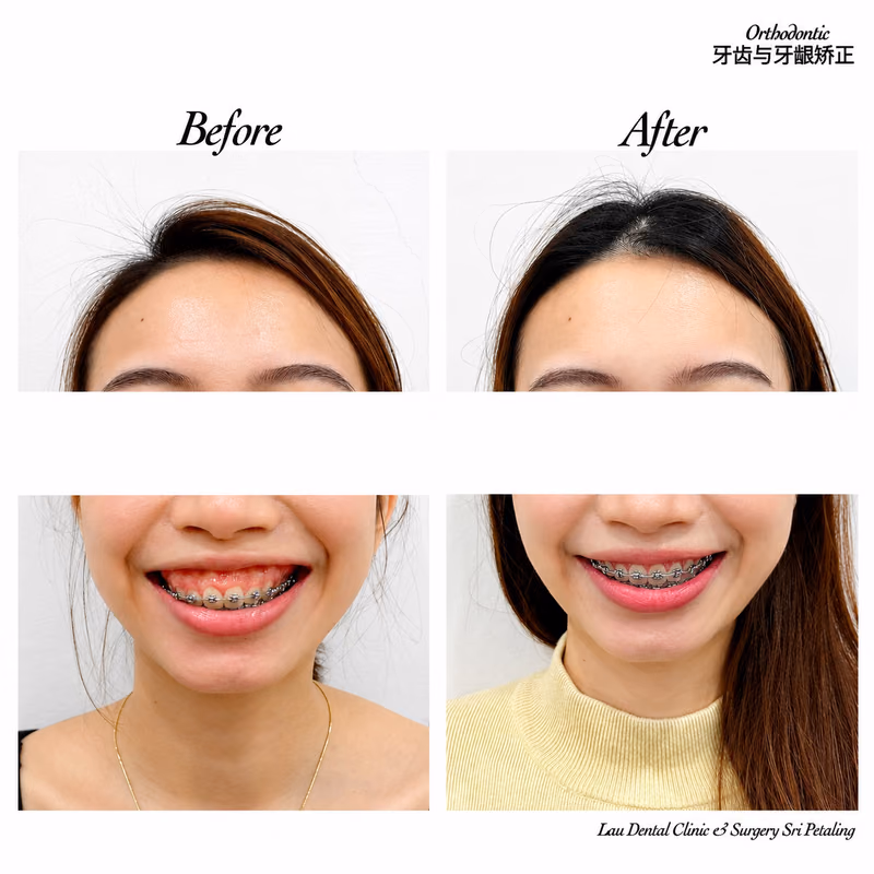 Before and after braces treatment improving gummy smile and smile alignment.