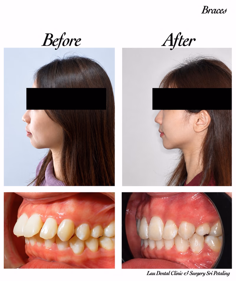 Before and after braces treatment showing improved side profile and teeth alignment at Lau Dental Clinic Sri Petaling.
