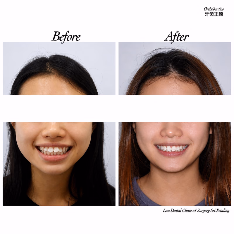 Before and after braces treatment improving teeth alignment and smile aesthetics.