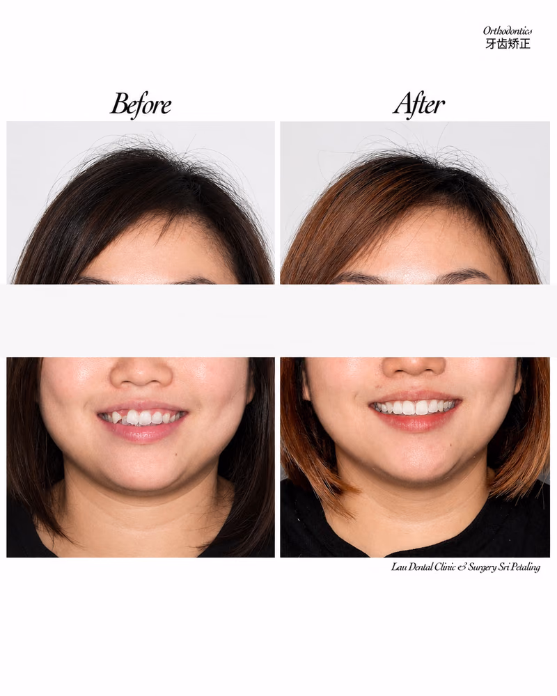 Before and after braces treatment improving smile alignment and facial symmetry.