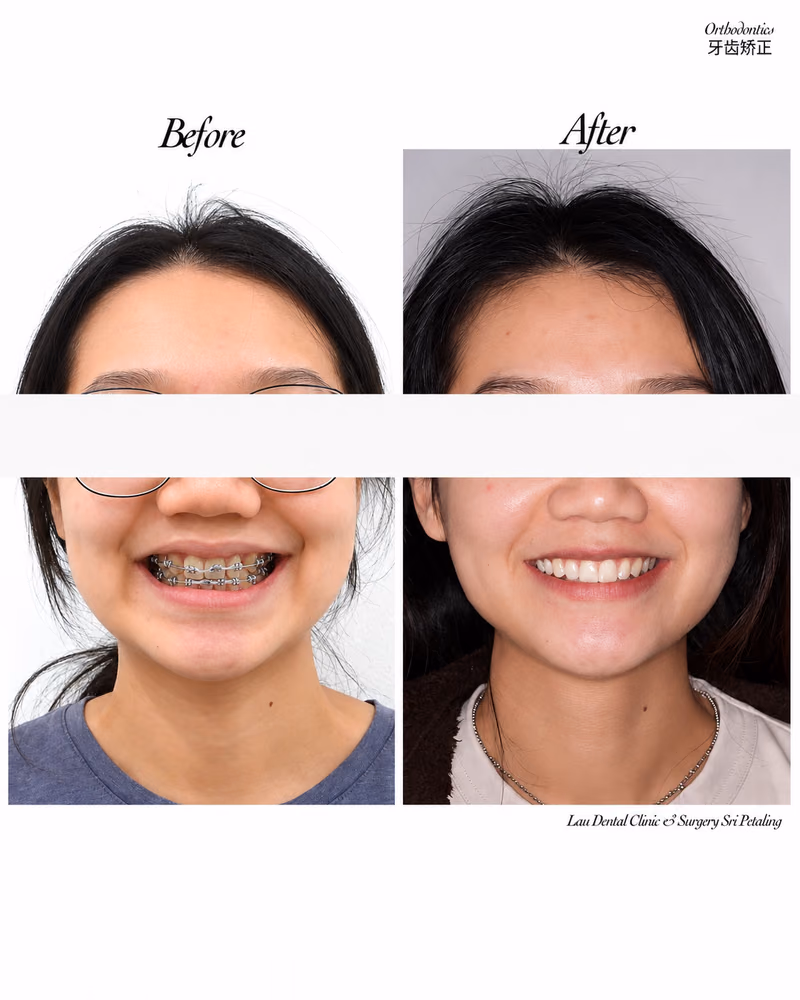 Before and after braces treatment improving teeth alignment and smile confidence.