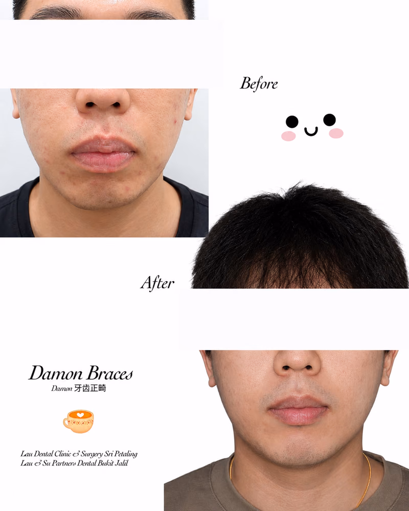 Damon braces before and after treatment improving facial symmetry and smile balance.