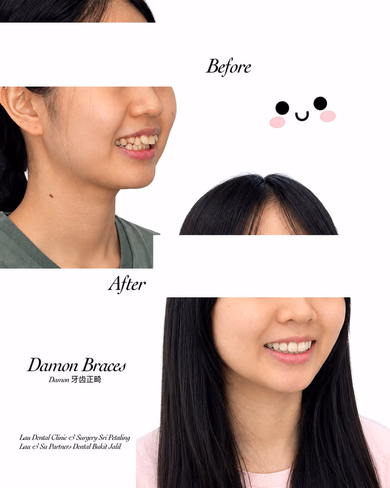 Damon braces before and after treatment improving overbite and smile alignment.