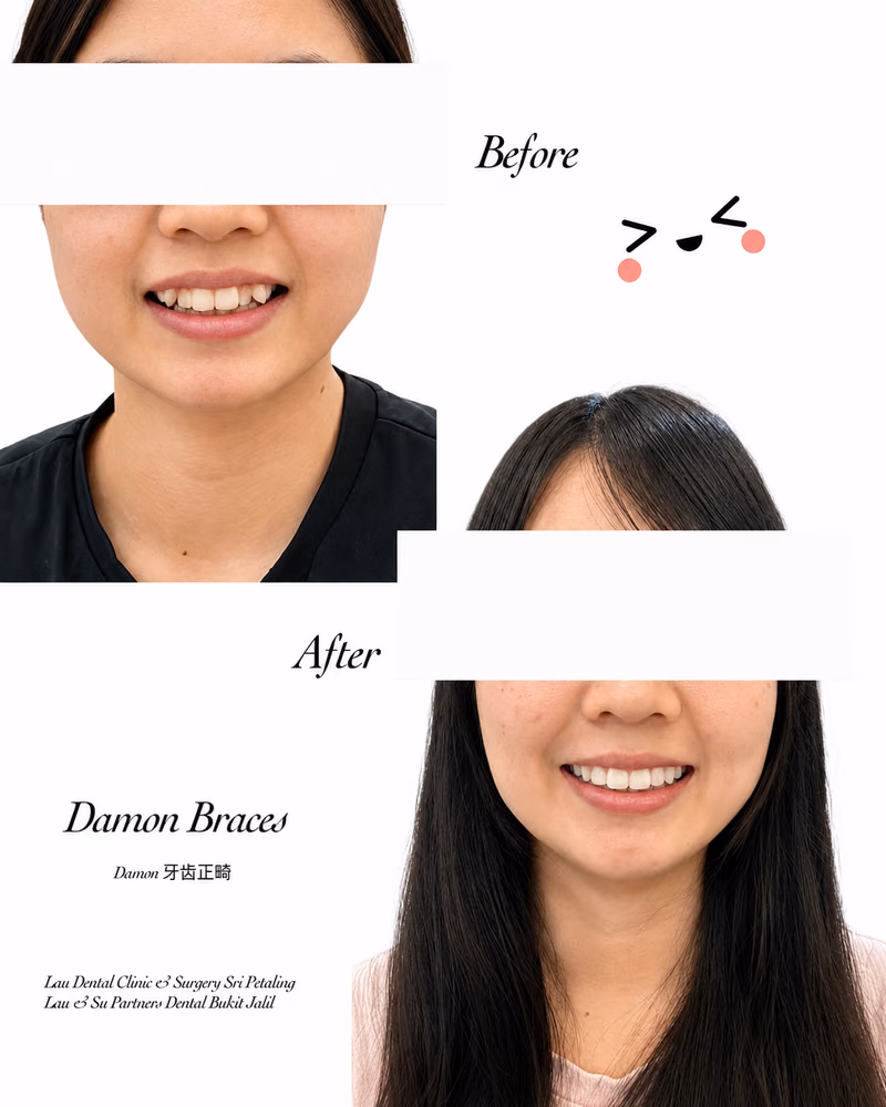 Damon braces before and after treatment improving teeth alignment and smile appearance.