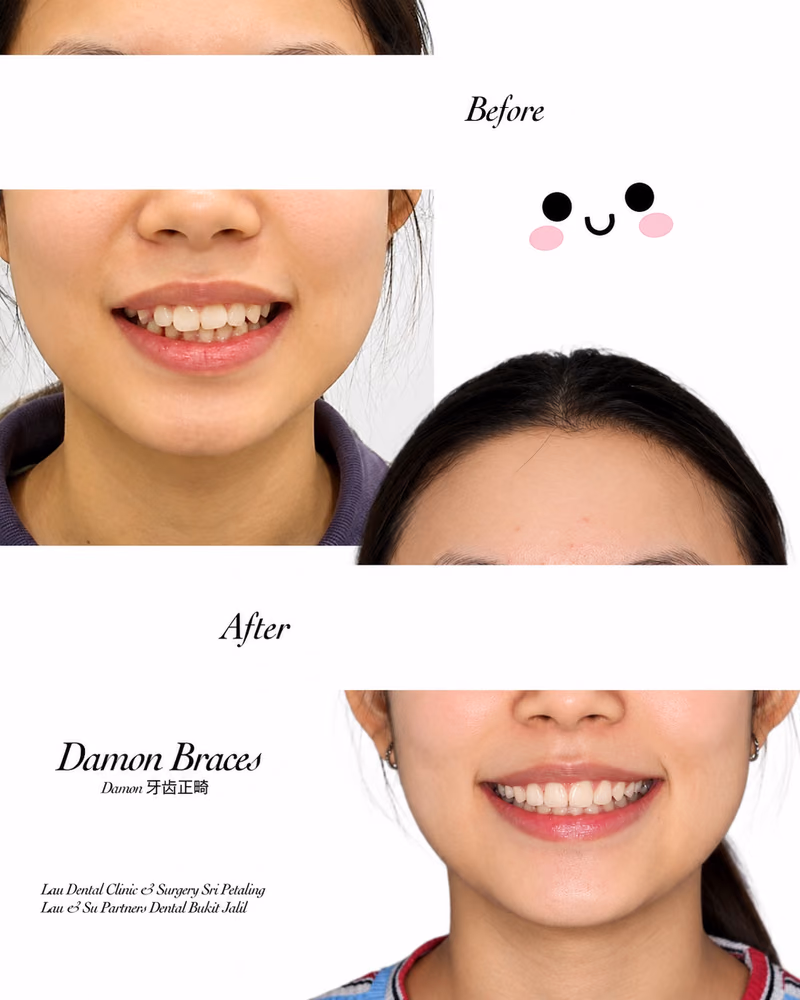 Before and after Damon braces treatment showing improved smile alignment at Lau Dental Clinic Sri Petaling.