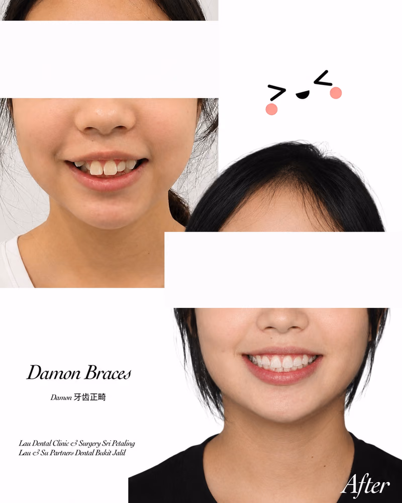 Damon braces before and after smile transformation for gap teeth and alignment correction.