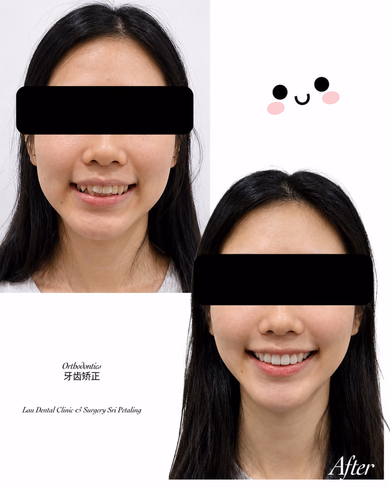 Before and after orthodontic treatment improving teeth alignment and smile aesthetics.
