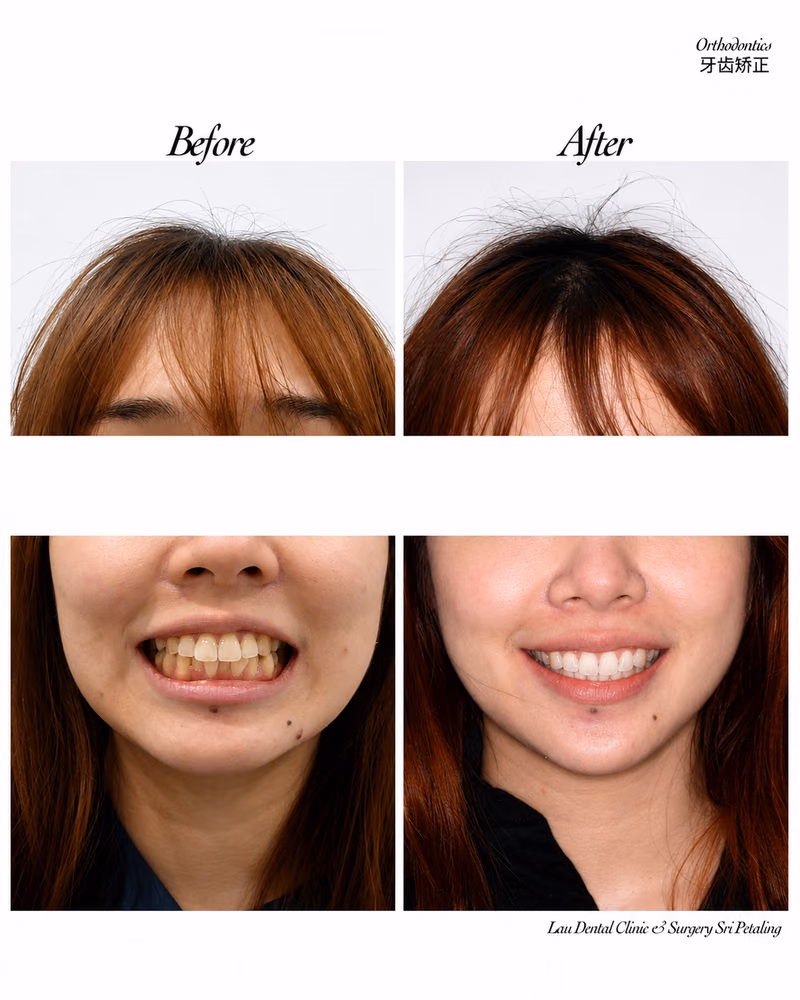 Before and after orthodontic treatment improving teeth alignment and smile aesthetics.