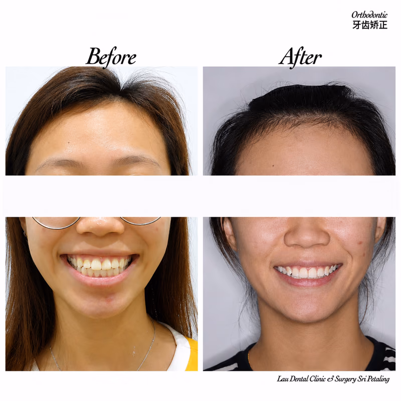 Before and after orthodontic treatment improving smile alignment and bite correction.