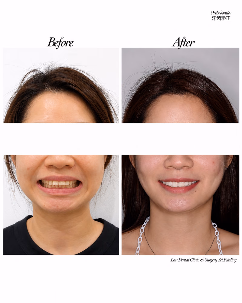 Before and after orthodontic treatment improving smile alignment and facial balance.