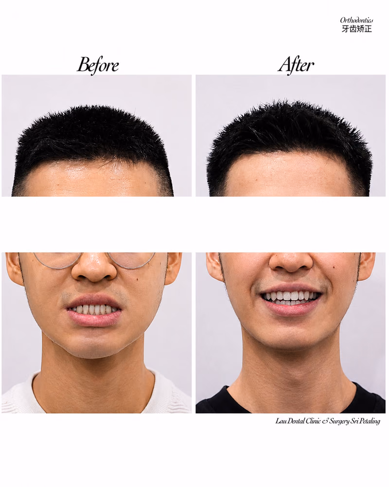 Before and after orthodontic treatment improving teeth alignment and smile appearance.