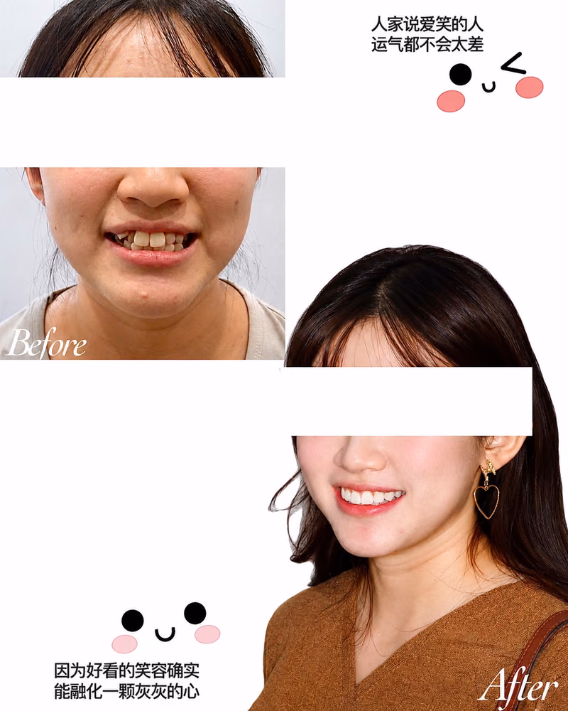 Before and after orthodontic treatment improving crooked teeth and smile aesthetics.