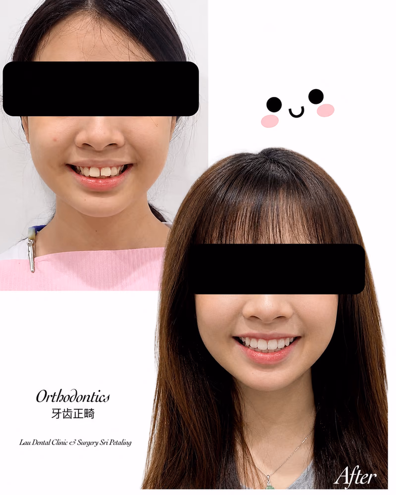 Before and after orthodontic treatment showing straighter teeth and a confident smile.