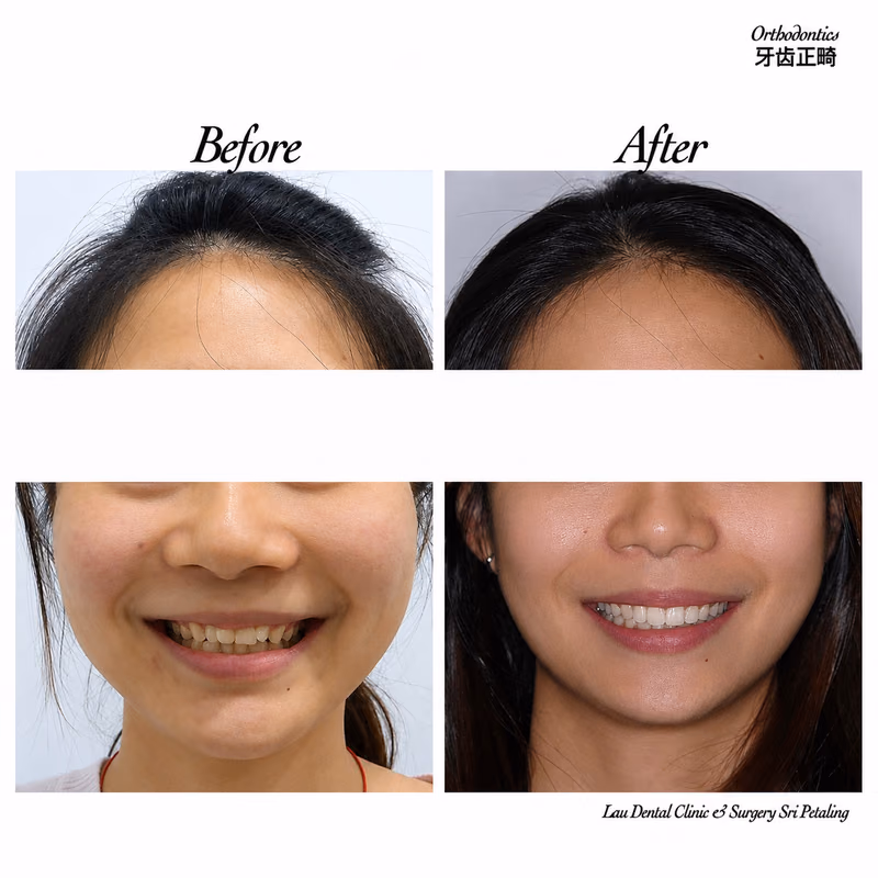 Before and after orthodontic treatment improving teeth alignment and smile aesthetics.
