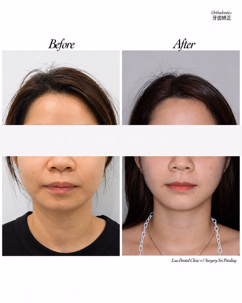 Before and after orthodontic treatment improving facial symmetry and jawline definition.