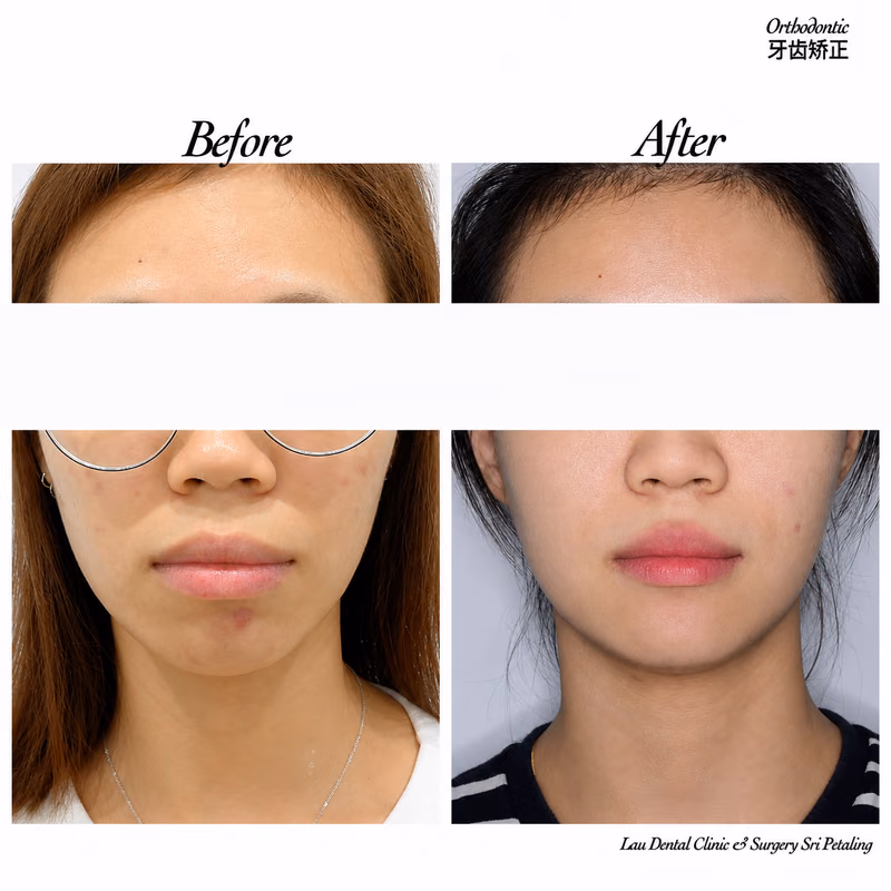 Before and after orthodontic treatment improving facial symmetry and chin alignment.