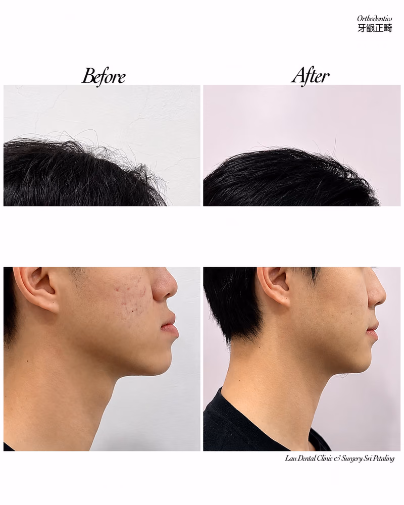 Before and after orthodontic treatment improving jawline definition and facial profile.