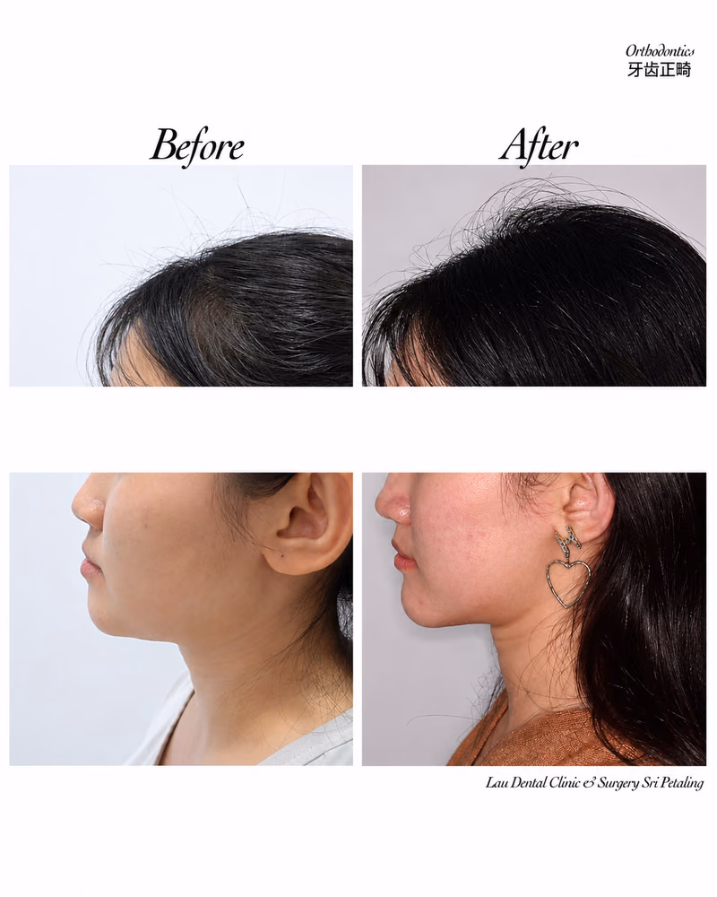 Before and after orthodontic treatment improving jawline definition and side profile balance.