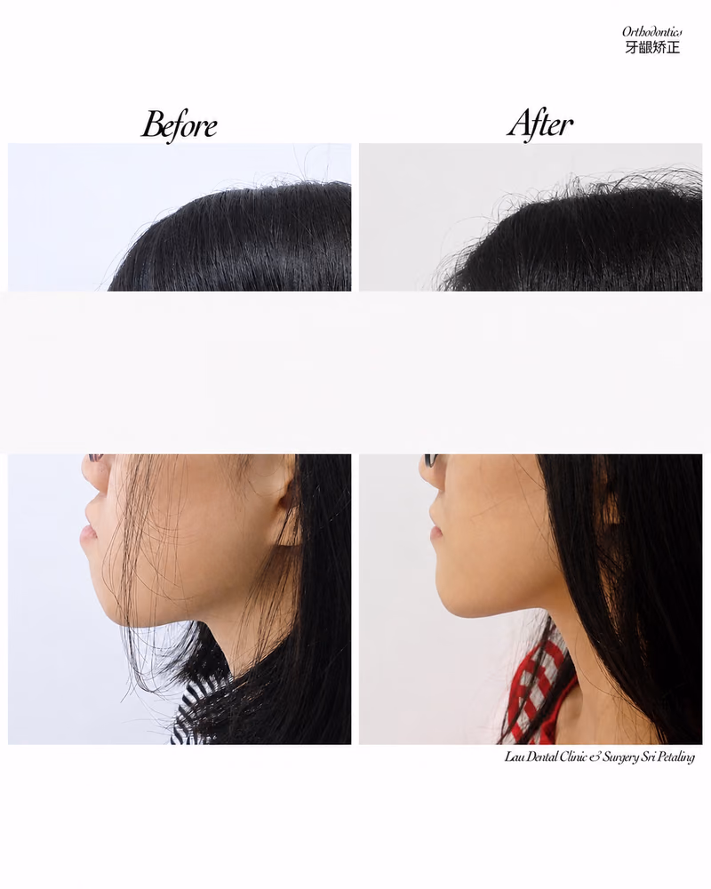 Orthodontic before and after jawline transformation after braces treatment.