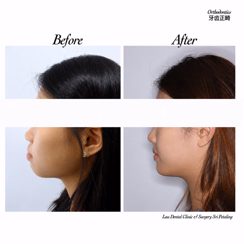 Before and after orthodontic treatment improving jawline definition and side profile.