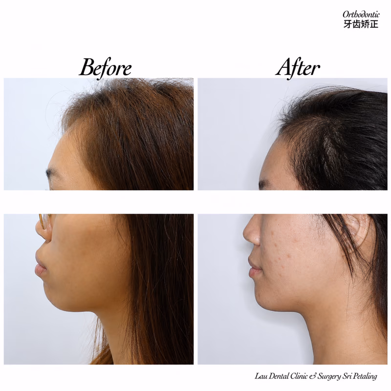 Before and after orthodontic treatment improving side profile and facial balance.