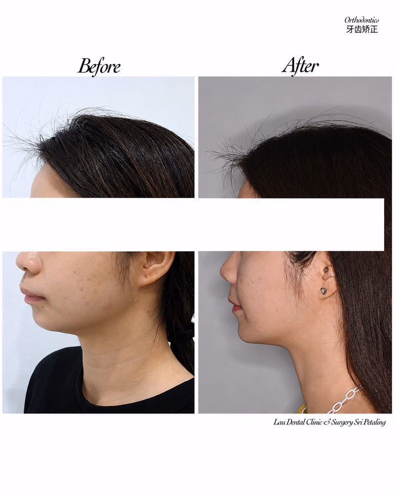 Before and after orthodontic treatment improving side profile and jawline balance.