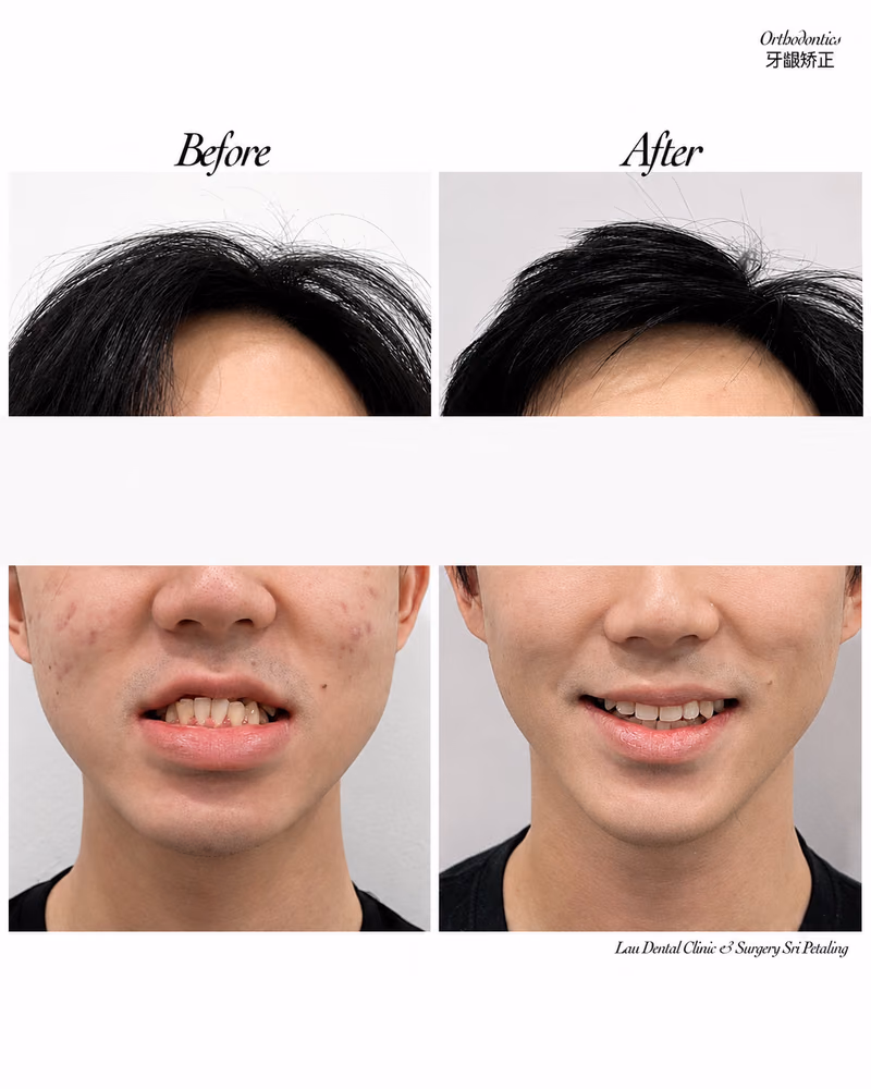 Before and after orthodontic treatment correcting crooked teeth and improving smile confidence.