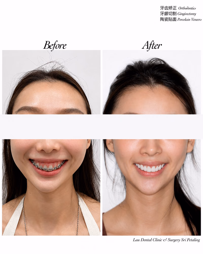 Before and after smile makeover with orthodontics, gingivectomy, and porcelain veneers at Lau Dental Clinic Sri Petaling.
