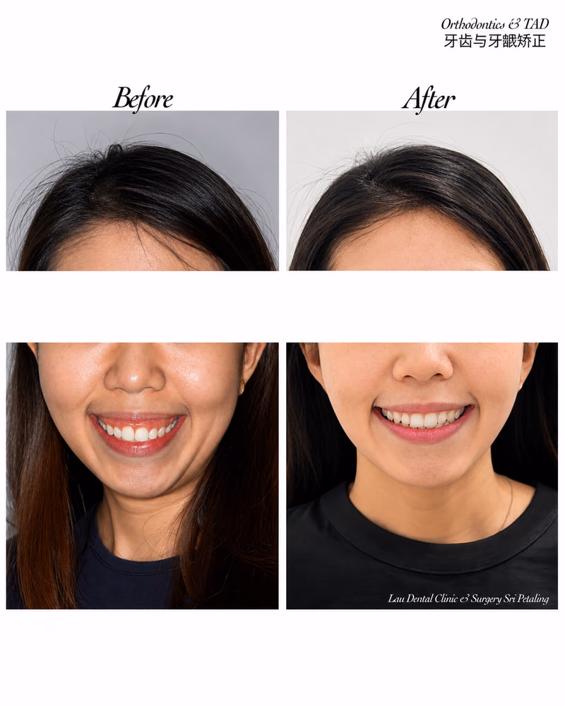 Before and after orthodontics with TAD treatment improving smile balance and teeth alignment.