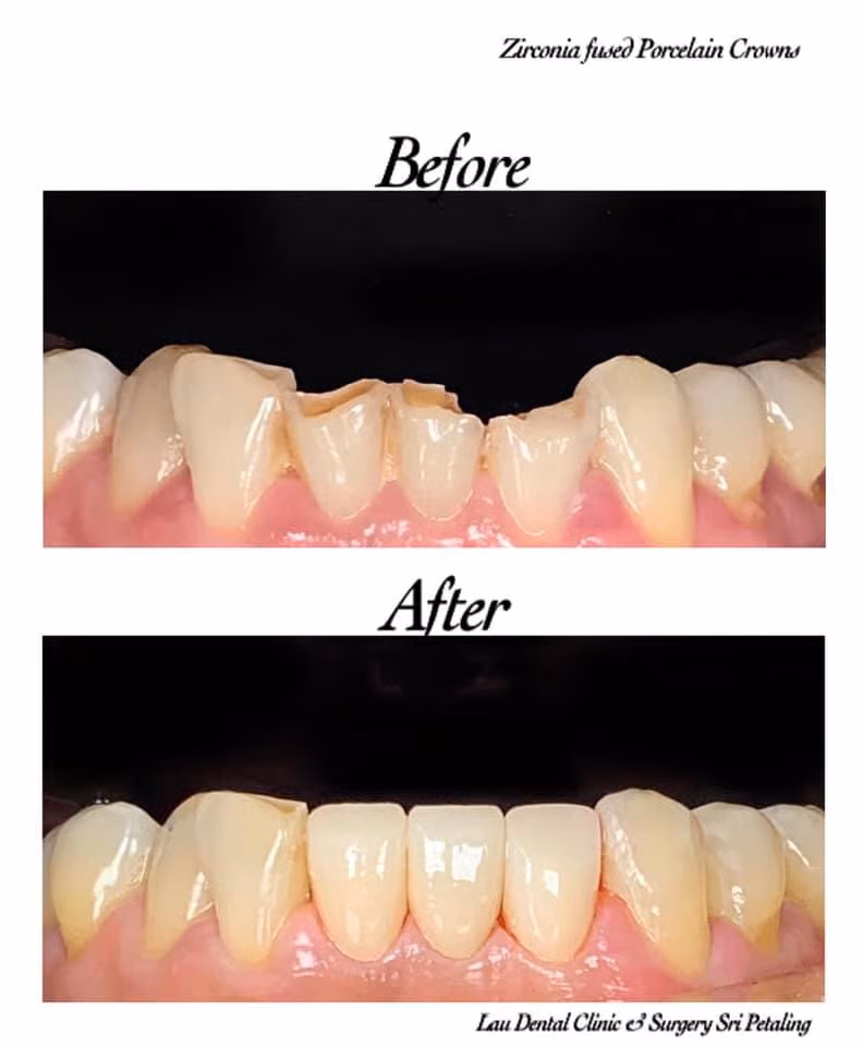 Dental crown and bridge restoration improving damaged and missing teeth appearance.
