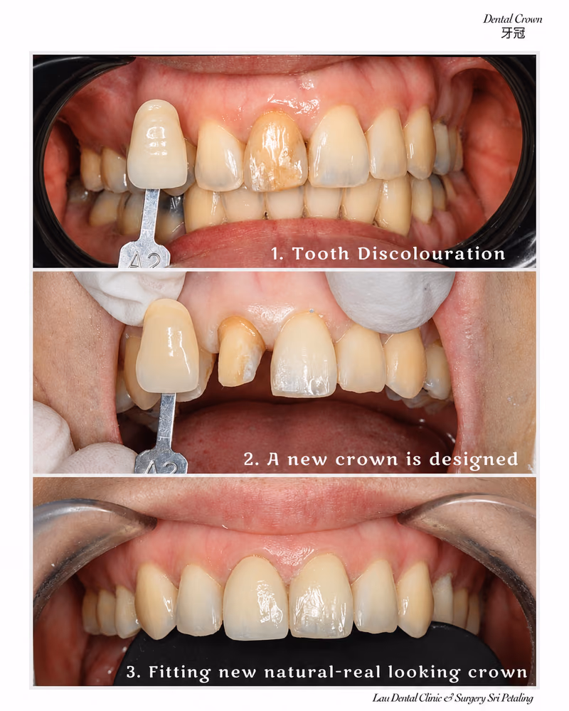 Dental crown treatment process showing tooth discoloration correction and natural-looking crown restoration.