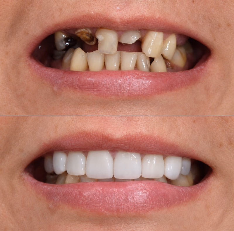 Dental crown restoration replacing blackened, severely damaged front teeth with a natural-looking smile.