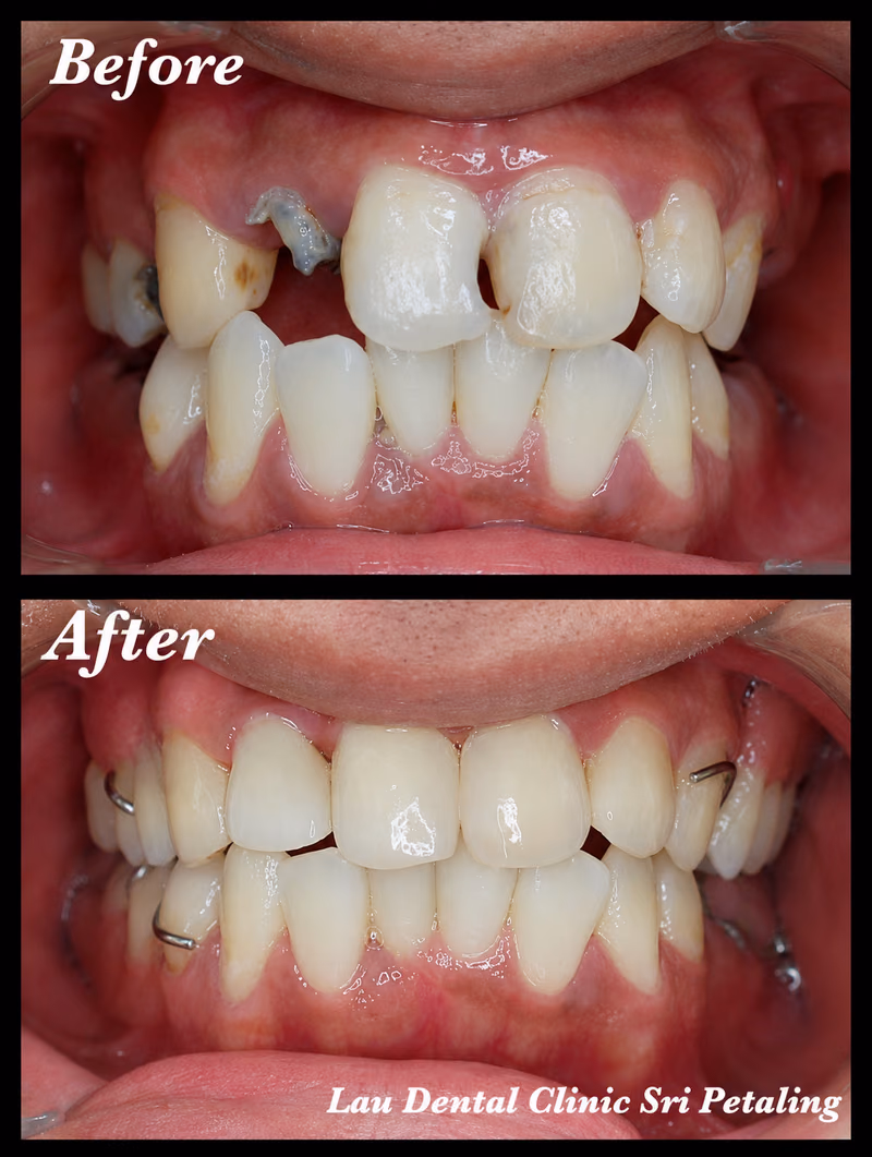 Full arch dental crown and bridge treatment restoring multiple broken teeth for improved dental function and a balanced smile.