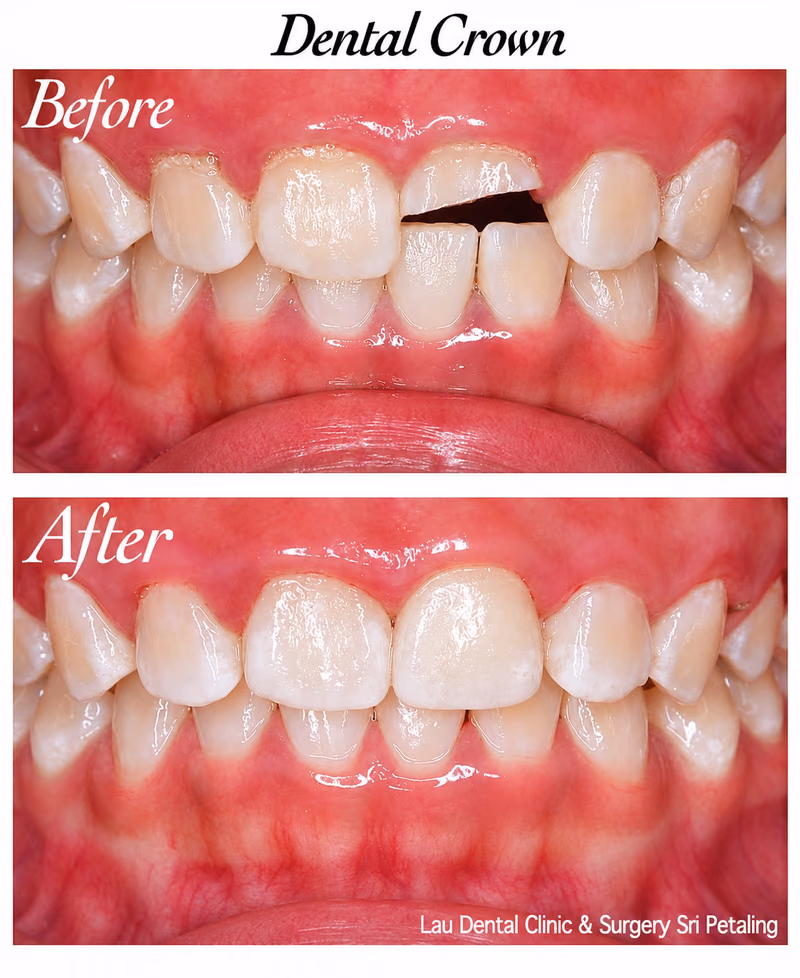 Dental crown restoring a fractured front tooth, rebuilding stronger tooth structure and natural appearance.