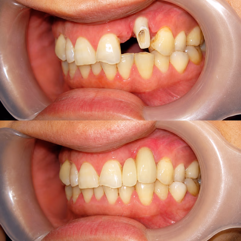 Side view of dental crown treatment restoring a fractured front tooth, replacing missing tooth structure.