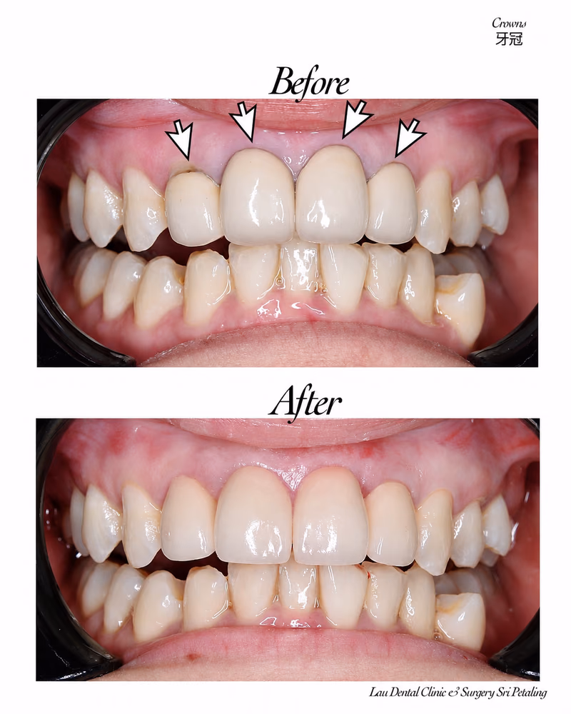 Dental crown treatment correcting gum recession around front teeth for healthier gums and improved smile aesthetics.