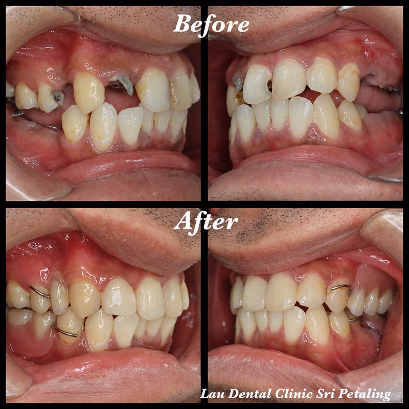 Side view of dental crown and partial denture restoration replacing missing teeth and rebuilding bite function.