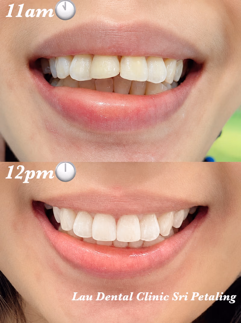 Dental crown treatment correcting discolored front teeth, completed within hours for a natural-looking smile.