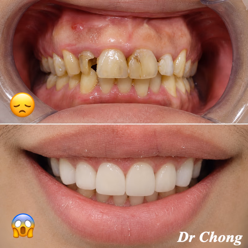 Dental crown smile makeover restoring severely decayed front teeth into a bright, natural-looking smile.