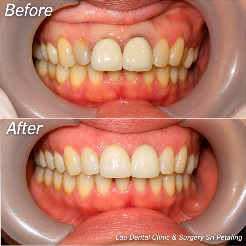 Dental crown treatment restoring stained upper teeth into a uniform, natural-looking shade and smile.