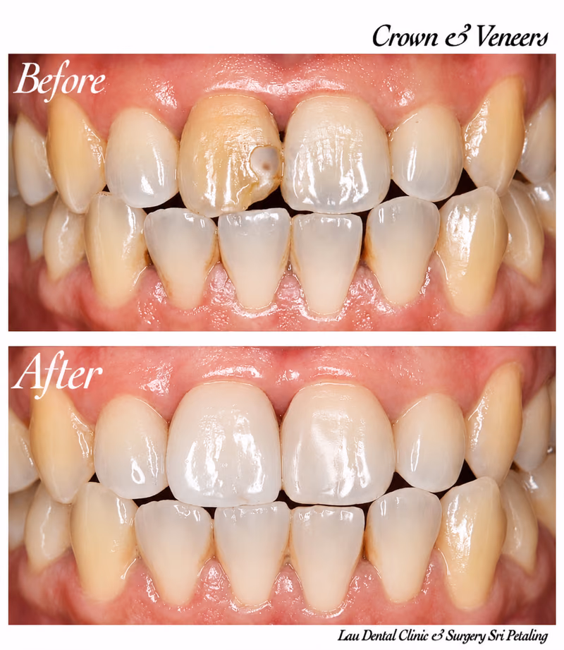 Combined dental crown and veneers treatment restoring a discolored front tooth for enhanced smile confidence.